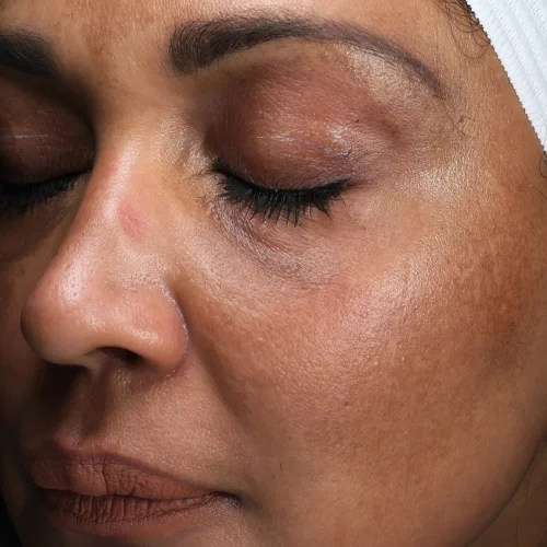 After laser facial treatments — Versha, 50