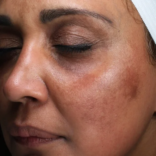 Before laser facial treatment — Versha, 50, Hyperpigmentation & Melasma