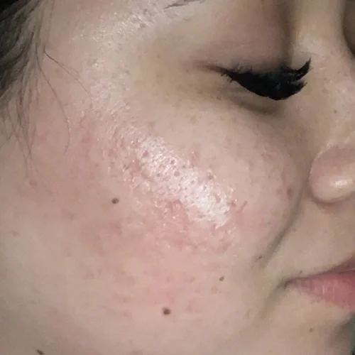 After laser facial treatments — Gabby, 28