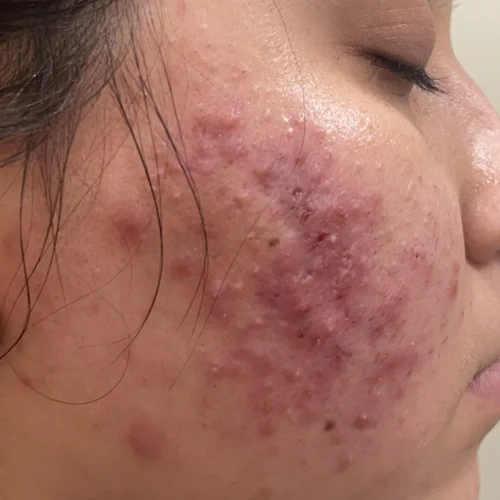 Before laser facial treatment — Gabby, 28, Acne & Acne Scarring