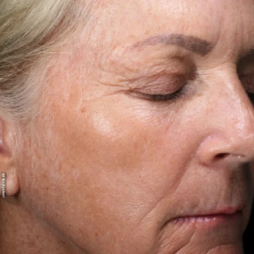 After laser facial treatments — Cyndi, 63