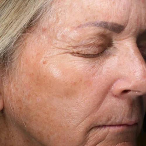 Before laser facial treatment — Cyndi, 63, Sun Spots, Fine Lines & Wrinkles