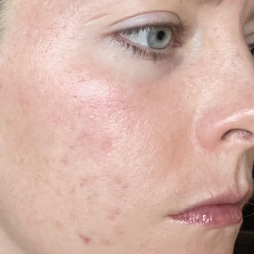 After laser facial treatments — Danielle, 36