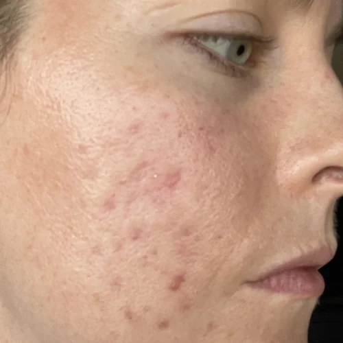 Before laser facial treatment — Danielle, 36, Acne & PIH (Post Inflammatory Hyperpigmentation)