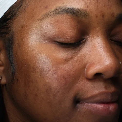 After laser facial treatments — Jalisa, 33