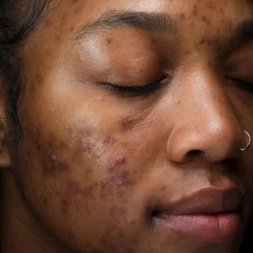 Before laser facial treatment — Jalisa, 33, Acne & PIH (Post Inflammatory Hyperpigmentation)